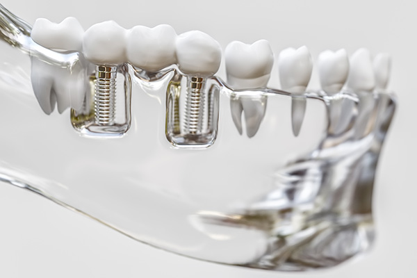 Dental Implants Land O Lakes, FL